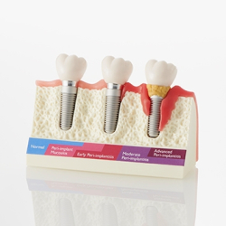 Peri-Implantitis Studiemodel